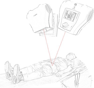 Illustration of the technique for monitoring prosthetic migration: Soon after surgery the patient is x-rayed against a reference plate with two beams. The tantalum markers in the bone and implant create polygons which show any movement over time when imaged periodically.