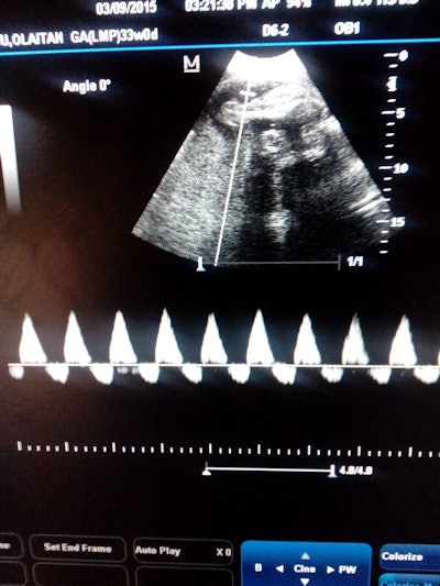 Ultrasound for poor fetal growth