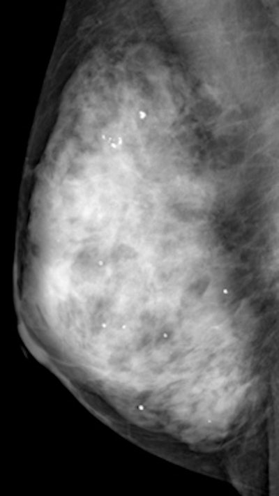 Mammography image of a dense breast. Although mammography is the only proven method of screening that reduces mortality, it is inaccurate in dense breasts, but adjunctive ultrasound can help. Image courtesy of Martin Yaffe, PhD.