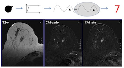 This shows an invasive lobular cancer. The lesion presents with spiculations, corresponding to positive root sign. The brightness between early- and late-enhanced phases stays the same, corresponding to plateau enhancement. Finally, the T2-weighted scan shows no perifocal brightness, edema is negative. The resulting node is 7, biopsy is recommended. In case someone would rather see a persistent enhancement, node 6 (still biopsy recommended) would be the result.
