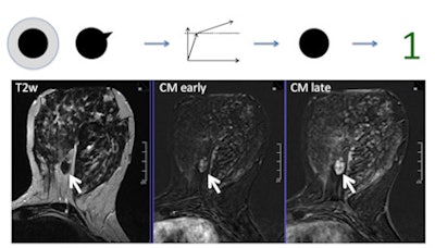 This shows a benign fibroadenoma. Following the Tree, it has no root sign, a persistent enhancement pattern (brighter in late as compared with early contrast enhanced image), and circumscribed borders, resulting in a node 1 (benign, minimum probability of cancer). No biopsy is necessary. In case the reporting radiologist would be unsure about the circumscribed margins, a node 3 (still benign) would result and still no biopsy should be performed.
