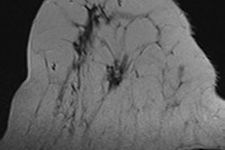 2015 11 10 17 36 50 288 2015 11 11 Breast Mri Thumb