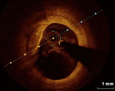 Thin-cap fibroatheroma at optical coherence tomography. Image courtesy of Dr. Mario Iannaccone.