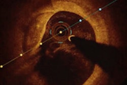 2015 11 13 09 12 46 853 2015 11 13 Fibroatheroma Thumb
