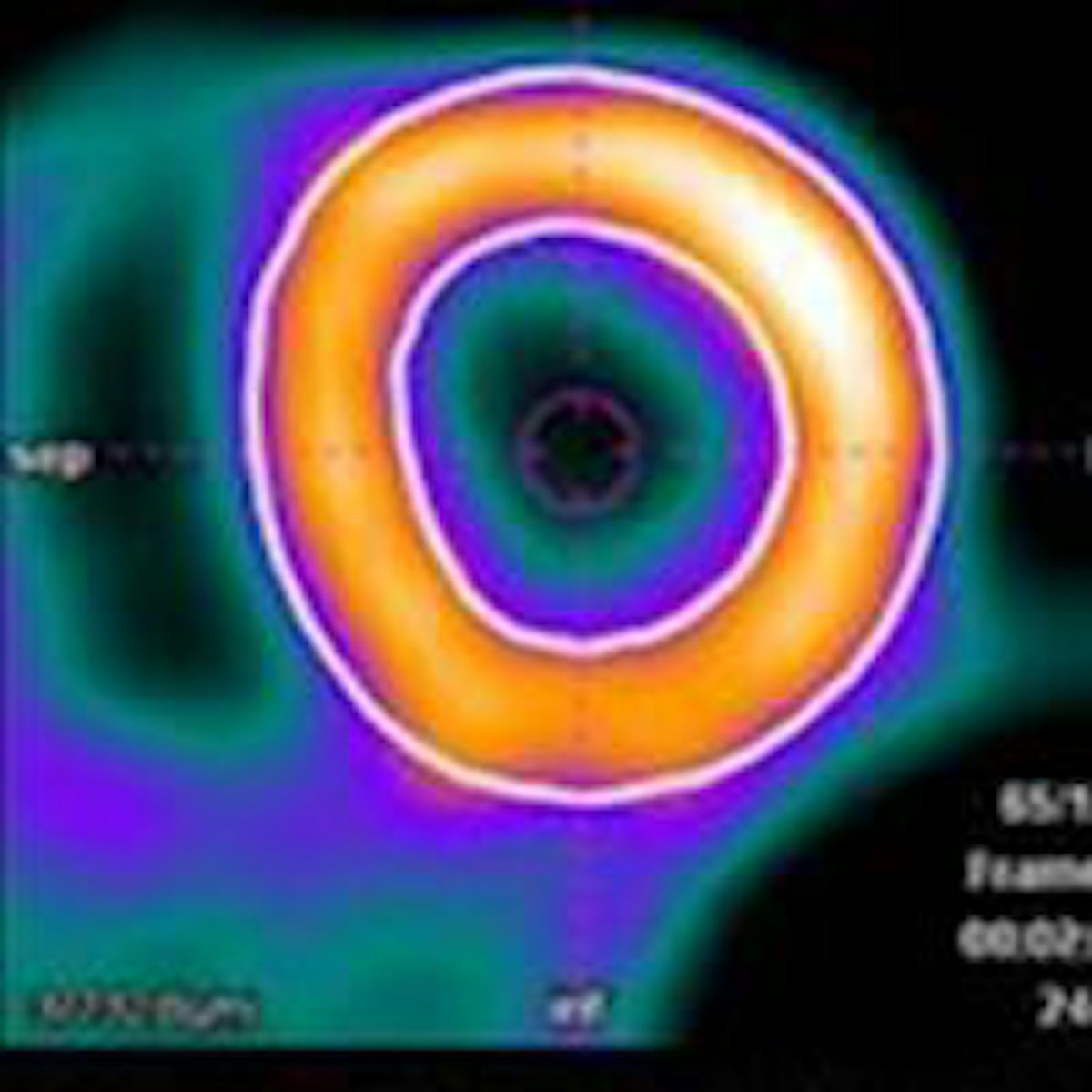 Rubidium PET/CT reveals vascular problems in diabetes patients ...