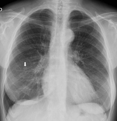 Preoperative x-ray