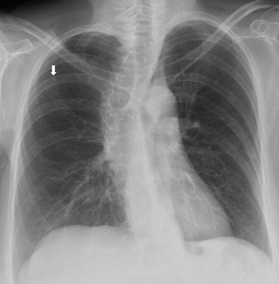 Top: Follow-up imaging of a 72-year-old woman. Preoperative x-ray for skin melanoma. Posteroanterior chest radiography in the upright position shows one suspected pulmonary nodule in the right lung (arrow). Bottom: Digital tomosynthesis image clarifies that the same opacity corresponds to a focal sclerosis within the poster arch of a right rib (arrow). Readers provided a confidence score of 1.