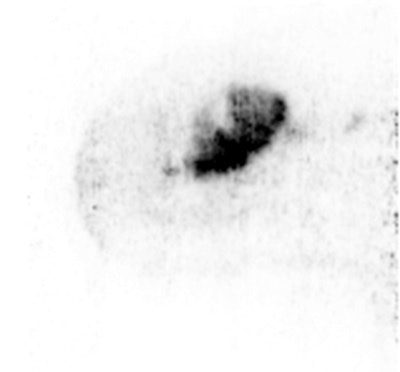 Sagittal Mammi-PET image shows one FDG-avid lesion. Inside the lesion, regions can be identified with different FDG uptake. This heterogeneity may be correlated in the future with different characteristics of the same tumor, when biopsies of the various regions are compared.