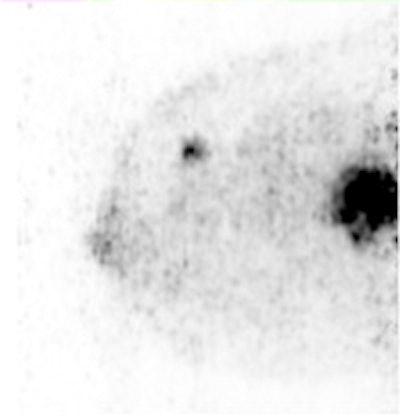 Sagittal Mammi-PET image shows two FDG-avid lesions. The smallest distal lesion, with a diameter of 2 mm, had been classified as benign (BI-RADS 2) on MRI. All images courtesy of Dr. Suzana Teixeira.