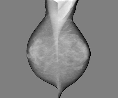 Images show mammography images processed with density-mapping software (Volpara), using the output of the dense area classifier. Top, original density map in grayscale; middle, density maps on the color scale; bottom, thresholded density map showing dense areas larger than 1 cm. All images courtesy of Katharina Holland.