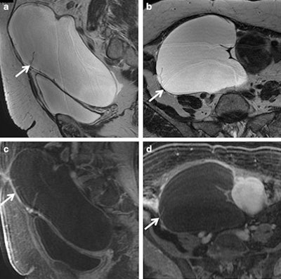 Serous cystadenoma in a 64-year-old woman. (a) Sagittal and (b) axial T2-weighted images show a hyperintense unilocular cystic mass (white arrows). On (c) sagittal and (d) axial contrast-enhanced fat-suppressed T1-weighted images, the cyst wall shows poor contrast enhancement (white arrows) without vegetations, nodularity, or solid components. All images courtesy of Dr. Pietro Valerio Foti.