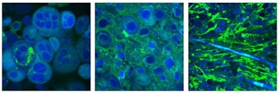 Stimulated Raman scattering (SRS) microscopy images. Left: brain metastasis from a lung carcinoma; center: human glioblastoma cells; right: infiltrative low grade oligodendroglioma, with tumor cells and an associated 'chicken wire' blood vessel seen in blue. Credit: Orringer and Xie Labs.