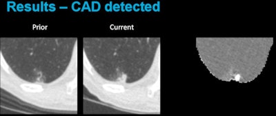 Above, CAD applied to subtraction-based registration of prior and current lung CT images detected a new nodule. Below, CAD did not detect a new nodule at the lung base that was not present on the baseline scan. All images courtesy of Colin Jacobs, PhD.