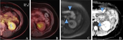 A 39-year-old woman with a histologically verified MALT lymphoma of the small intestine. The color-coded, fused FDG-PET/CT (A) and FDG-PET/MRI (B) show no increased tracer uptake. However, the DWI image (C) and the corresponding ADC map (D) clearly demonstrate the extranodal lymphoma involvement (light blue arrowheads in C and D). Images courtesy of Dr. Chiara Giraudo.