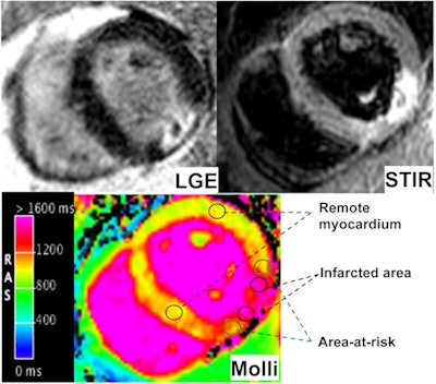 Patient with myocardial infarction seen with late gadolinium enhancement (upper left), STIR, upper right, and T1 MOLLI image depicting infracted area, area at risk, and remote myocardium. All images courtesy of Dr. Nicola Galea.