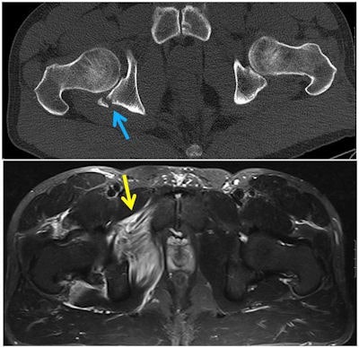 A 40-year-old male mountain biker presented with acute, right-sided hip pain after hitting an unexpected dip while riding a downhill single track in the dark. Axial CT image (top) shows a right posterior acetabular fracture (blue arrow). Axial T2-weighted fat-suppressed MRI (bottom) demonstrates a tear of the right adductor magnus (yellow arrow). All images courtesy of Drs. Daichi Hayashi, PhD, Richard de Villiers, and Shaun Scheepers.