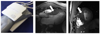 Left: Picture of the 16-channel transmit/receive radiofrequency antenna designed and developed for this 7-tesla cardiac MRI study. Middle: Three-chamber view of the heart of a patient with hypertrophic cardiomyopathy shows subtle myocardial crypts highlighted by the white arrow. Image was acquired at 7 tesla. Right: Short-axis view of the heart of a patient with hypertrophic cardiomyopathy showing myocardial crypts highlighted by the white arrow. Image was acquired at 7 tesla. Images courtesy of Thoralf Niendorf, PhD.