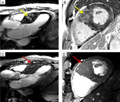 Images show fibrosis at 3-tesla MRI (top row, yellow arrow) with a long-axis view (A) and short-axis view (B). Cine imaging at 7 tesla (bottom row) indicates the myocardial crypts (red arrow) in long-axis view (C) and short-axis view (D). Fibrosis and crypts have a certain overlap. One may assume the bright signal at 3-tesla also might be induced by blood within the crypts. Images courtesy of Dr. Jeanette Schulz-Menger.