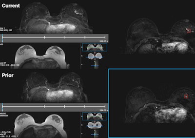 Cirrus Breast MRI, the research workstation developed at the university's Diagnostic Image Analysis Group to retrospectively evaluate DCE-MRI current-prior pairs and display CAD markers. The workstation provided T1-weighted subtraction and maximum intensity projection (MIP) images for all the time points of current (above) and prior (below) scans. CAD detected the invasive ductal carcinoma in the sample in both current and prior-negative examinations (markers shown as red boxes). This exam was originally assessed as BI-RADS 1 during screening. All images courtesy of Dr. Albert Gubern-Mérida.