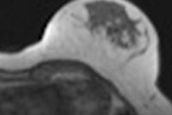 2016 02 22 14 51 29 265 2016 02 23 Breast Mri Cirrus Mri Cad 20160222215701