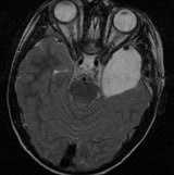 Arachnoidal cyst