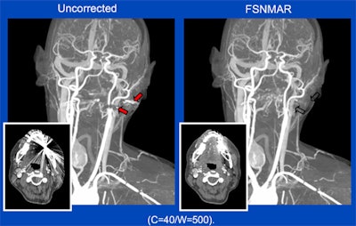 Metal artifacts in CT can be caused by very dense (x-ray opaque) objects, such as metal implants or highly concentrated intravenous contrast agents. In the shadow of the metal objects, virtually no primary x-rays are received by the detector and a conventional reconstruction will, thus, produce significant artifacts (left). A new algorithm -- frequency-split normalized metal artifact reduction (FSNMAR), or iterative metal artifact reduction (iMAR) -- helps to fill in the missing data with consistent values, thereby outperforming other known metal artifact reduction techniques. Images courtesy of Dr. Thomas Beyer.