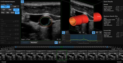 Screen capture demonstrates Samsung's S-3D Arterial Analysis technology for cardiovascular investigations.