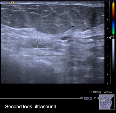 Second-look ultrasound of the lesion. It's an oval, horizontally oriented lesion with circumscribed borders, posterior acoustic enhancement, and no hypervascularization. Internal features unspecific hypoisoechoic. It was found to be probably benign on ultrasound, and followed up over two years without evidence of growth.
