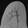 2016 03 02 19 02 44 811 2016 03 03 Ecr Today Breast Errors Image Thumb