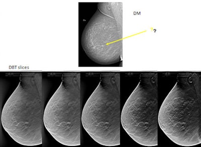 Tumor not easily seen on 2D digital mammography. With 3D DBT, it is obvious there is a spiculated tumor. This shows five tomosynthesis slices in which the lesion is in focus. The breast is not especially dense, but a small amount of overlapping tissue is enough to hide the tumor on digital mammography. Images courtesy of by Dr. Sophia Zackrisson, Skåne University Hospital, Malmö.
