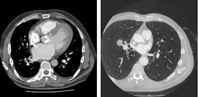 Left: Patient presenting with dyspnea. Contrast-enhanced CT chest demonstrates extensively calcified aortic valve with signs of heart failure. Right: Patient presenting with angina. The coronary CT angiography showed nonflow limiting coronary artery disease, but the full field-of-view reconstruction diagnosed lung cancer in the right middle lobe. Images courtesy of Dr. Edwin van Beek, PhD.
