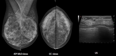Both mammographic views (mediolateral oblique and craniocaudal) are normal on these heterogeneously dense breasts. Ultrasound detects a 5-mm invasive ductal carcinoma. Images courtesy of Dr. Luis Pina Insausti.
