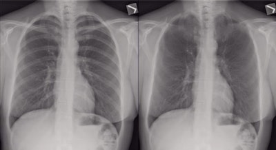 Left, chest radiograph; right, bone suppression. Image courtesy of Dr. Yun Wang.