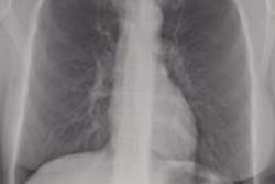 2016 03 04 11 43 35 180 2016 03 04 Bone Suppression 20160304184402