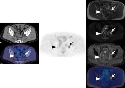 Left: F-18 choline PET/CT (CT top and fused PET/CT bottom). Center: F-18 choline PET. Right: MRI (from top to bottom: T1, b900 diffusion-weighted image [DWI], apparent diffusion coefficient [ADC] map, fused PET/T1 MRI). These images show an enlarged choline-avid left pelvic lymph node in a man with high-risk Gleason 4+5 prostate cancer. This is clearly seen (arrow) on the PET/CT images, as well as on all the MRI sequences (high signal on b900 and restricted diffusion on ADC map). There is a small equivocal focus of uptake on the PET scan in the right side of the pelvis (arrow head), but it is difficult to confirm this is a lymph node on the CT and fused PET/CT images. The MRI sequences confirm a small lymph node with high signal on b900 DWI and restricted diffusion on ADC map (arrowhead). This case shows how the superior tissue contrast and anatomical resolution of MRI sequences allow a better definition of the cause of the right-sided pelvic PET activity and a much more confident diagnosis of right as well as left lymph node involvement. All images courtesy of Dr. Gary Cook.