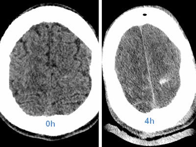 Above: CT head scan with increasing visibility of intracranial hemorrhage in the first few hours. Left: Unenhanced head CT; bleeding is hard to depict. Right: Control scan four hours after whole-body CT, and thus after contrast enhancement. Below: Images show traumatic rupture of the bowel. Images courtesy of Dr. Stefan Wirth.