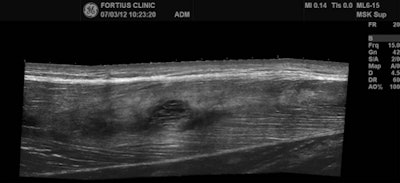 Extended field-of-view ultrasound demonstrates loculated hematoma at the musculotendinous junction with surrounding increased reflectivity within the rectus femoris muscle. Images courtesy of Dr. Justin Lee, Chelsea and Westminster Hospital, London.