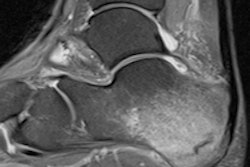 2016 03 04 17 29 21 744 Mri Stress Fracture 200