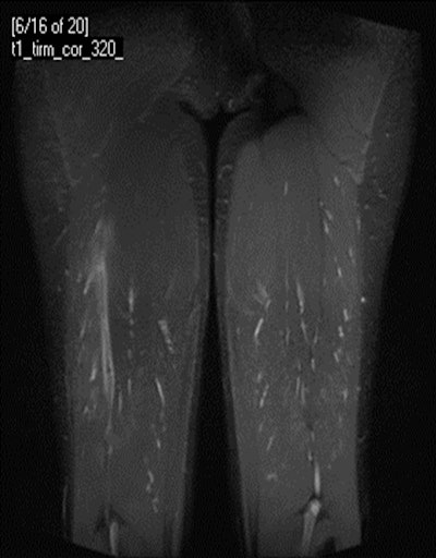 A 24-year-old male professional football player who presented with sudden onset of pain following striking of the ball. Coronal STIR MRI demonstrates focal defect within the left rectus femoris central muscle at the musculotendinous junction (grade II strain). Note the feathery edema pattern within the muscle radiating from the primary injury site.