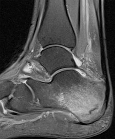 27-year-old female marathon runner. Sagittal STIR MRI shows calcaneal stress fracture paralleling posterior cortex with surrounding marrow edema. Image courtesy of Dr. Justin Lee, Chelsea and Westminster Hospital, London.