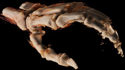 3D image of a hand taken with Siemens' Multitom Rax twin robotic x-ray system. Copyright: Clinic for Radiology and Nuclear Medicine, Basel University Hospital, Switzerland. Image courtesy of Siemens.