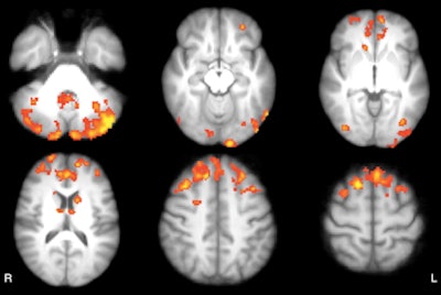 Axial statistical maps show areas of reduced thalamic functional connectivity in patients with MS compared with healthy subjects. Patients exhibited significantly lower functional connectivity in clusters located in the cerebellum, frontal and occipital cortices, caudate nucleus, and thalamus, bilaterally. Image courtesy of Radiology.