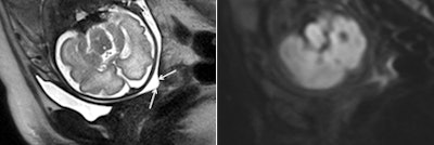Images are from a 28-year-old woman at 30 weeks of gestation with a sonographic cervical length of 8 mm who was referred for suspected corpus callosum dysgenesis. MRI (left) shows a short cervix with funneling (arrows), with the cervical canal appearing as a zone of high signal intensity. Diffusion-weighted MRI (right) illustrates a uniform hypointense subglandular area of the cervix without any restriction of diffusion.
