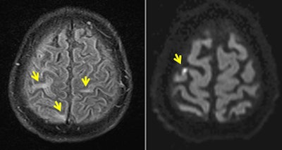 Left: FLAIR image shows multiple cortical hyperintensities in patient with Zika virus. Right: DWI reveals small infarct with restricted diffusion in same patient. Images courtesy of Dr. Pierre Brugières.