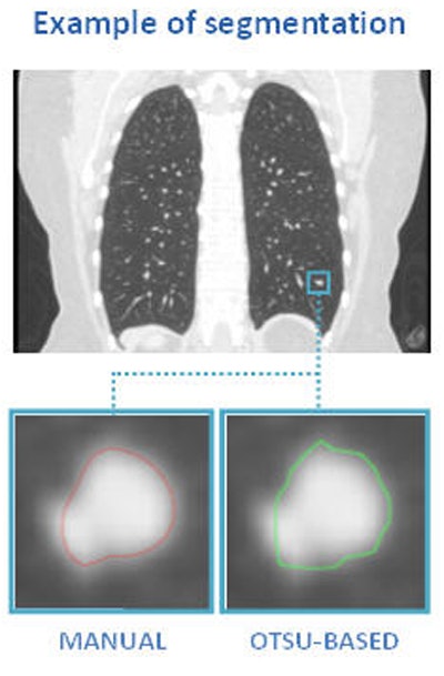 Above, nodule contouring by manual and semiautomated techniques. Below, agreement between nodule contouring measurements is only moderate between the two techniques, but classification results are uniformly high for both techniques. All images courtesy of Julien Willaime, PhD.