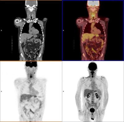 PET/CT scans show the remaining surviving cancer cells after treatment. Images courtesy of University of Birmingham.