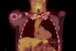 2016 03 23 14 42 07 842 2016 03 24 Pet Ct Mehanna Image 20160323214423