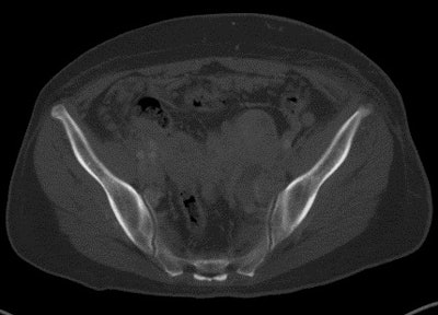 A 59-year-old woman with disseminated bone marrow metastases of a malignant melanoma, which were mostly occult on CT images. Above: CT image. Below: PET image. All images courtesy of Dr. Georg Bier.