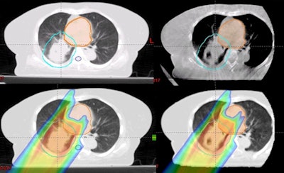 Top row (left to right): The planning CT and CBCT. Bottom row: The dose distribution on the planning CT, and on the virtual CT generated from the CBCT. Images courtesy of Boon-Keng Teo, PhD.