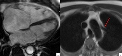 Above: Anomalous venous return can mimic ARVC/D. (A) In four-chamber view, right ventricle dilated; (B) left, upper pulmonary vein on the left side of aortic arch (arrow) draining upwards toward the brachiocephalic trunk. Below: Atrial septal defect can mimic ARVC/D. Large superior interatrial defect is seen with blood flowing from the left to the right atrium (arrow).